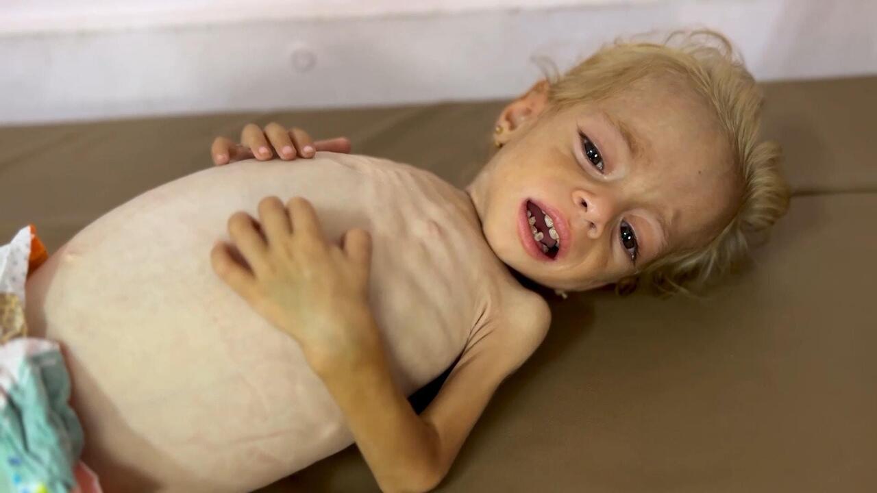 "قد تفارق الحياة في أي لحظة"... طفلة من غزة تعاني من سوء تغذية حاد وتضخم في الكبد
