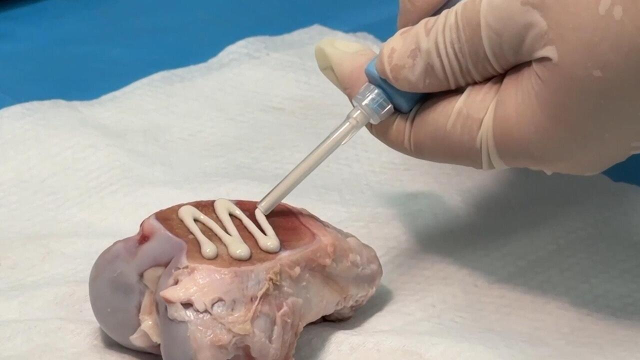 Stuck on you! - Chinese experts make revolutionary 'bone glue' breakthrough