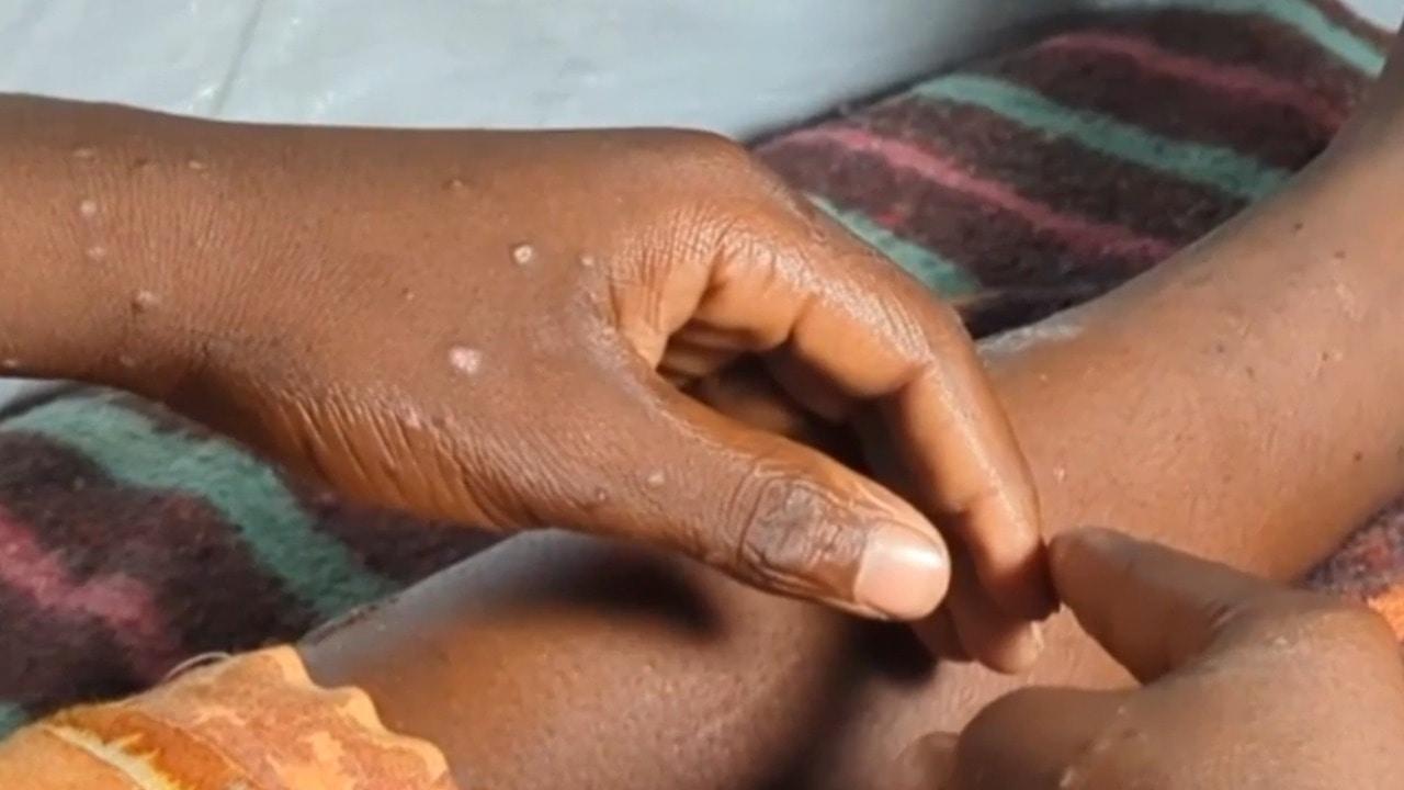 DRC Mpox fightback - Health authorities report decline in cases following major campaign

